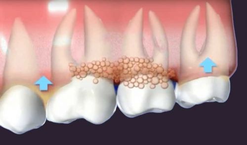 diagram-depicting-gum-disease-opt-768x452